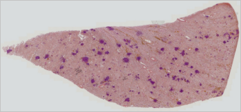 Kidney with Candida infection captured by Image Stitching module for QuickPHOTO